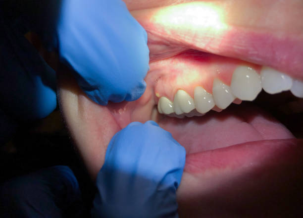 Best Root Canal Emergency Dentist  in Fruitridge Pocket, CA